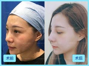 鼻子整容失败照片,揭秘鼻子整容失败案例背后的教训