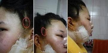 削骨照片,揭秘削骨手术前后对比照片背后的故事